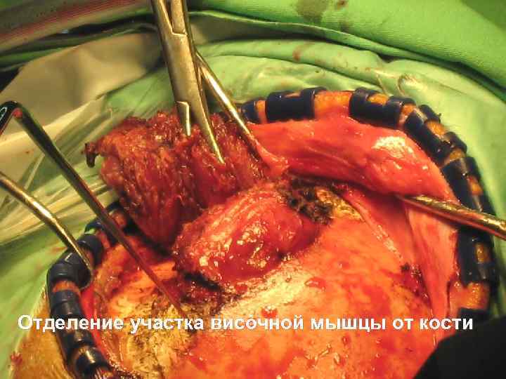 Отделение участка височной мышцы от кости 51 