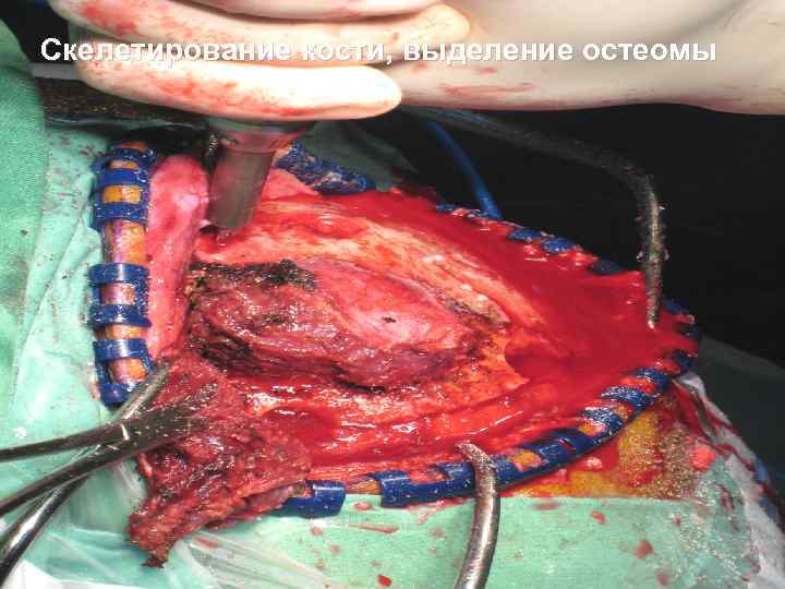 Скелетирование кости, выделение остеомы 52 