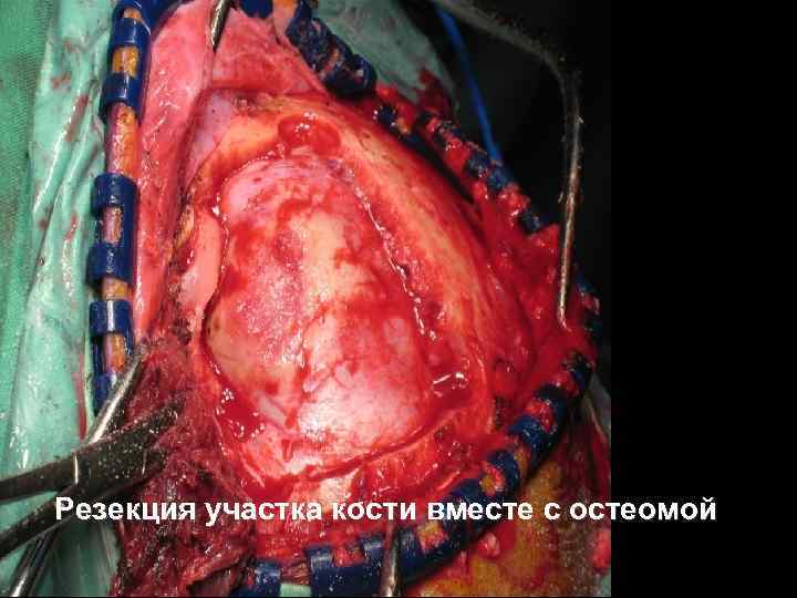 Резекция участка кости вместе с остеомой 53 