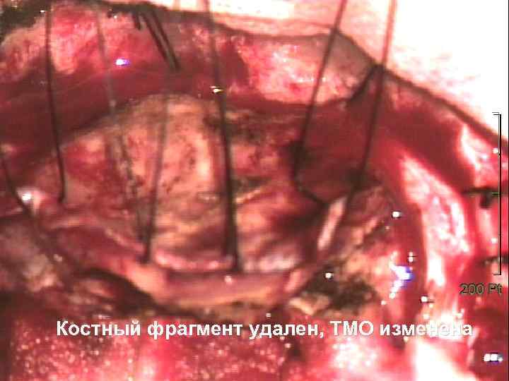 Костный фрагмент удален, ТМО изменена 54 