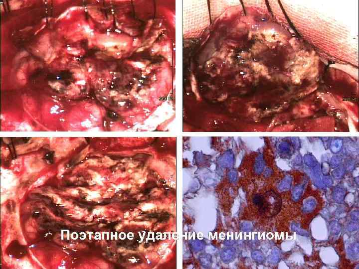 Поэтапное удаление менингиомы 55 