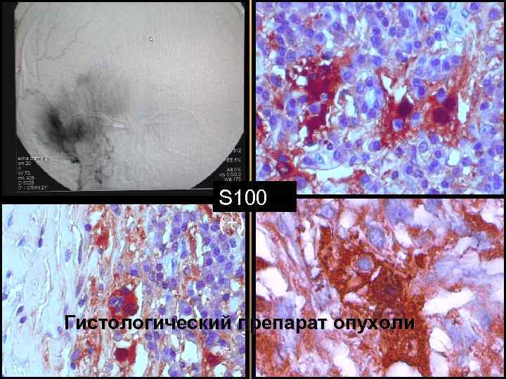 S 100 (+) Гистологический препарат опухоли 56 