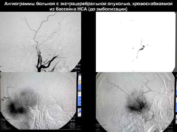 Ангиограммы больной с экстрацеребральной опухолью, кровоснабжаемой из бассейна НСА (до эмболизации) 57 