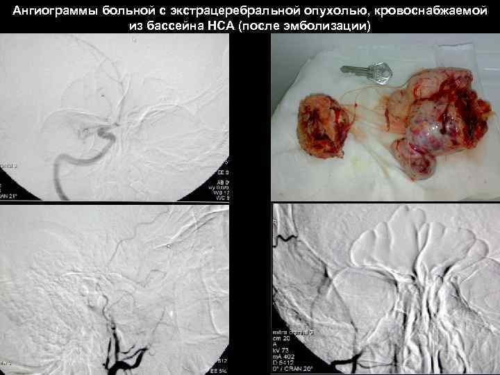 Ангиограммы больной с экстрацеребральной опухолью, кровоснабжаемой из бассейна НСА (после эмболизации) 58 