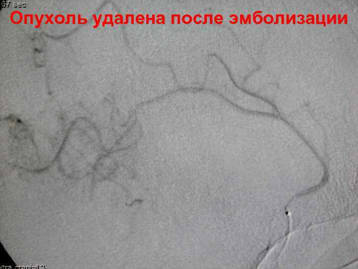 Опухоль удалена после эмболизации 59 