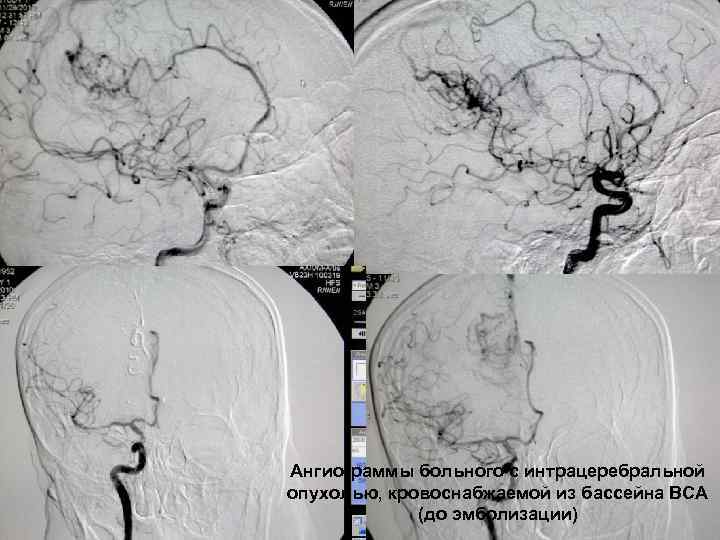 Ангиограммы больного с интрацеребральной опухолью, кровоснабжаемой из бассейна ВСА 60 (до эмболизации) 