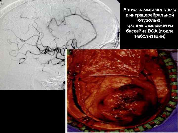 Ангиограммы больного с интрацеребральной опухолью, кровоснабжаемой из бассейна ВСА (после эмболизации) 61 