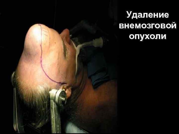 Удаление внемозговой опухоли 62 