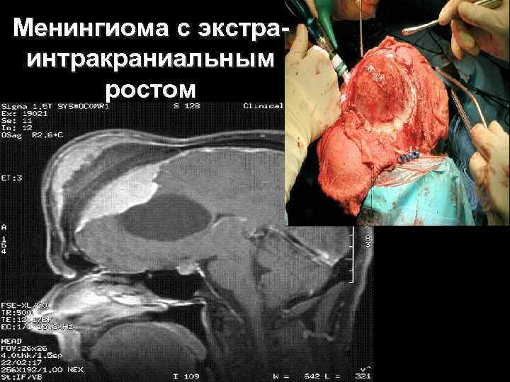 Менингиома с экстра интракраниальным ростом 63 