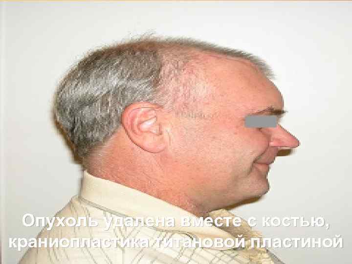 Опухоль удалена вместе с костью, краниопластика титановой пластиной 65 
