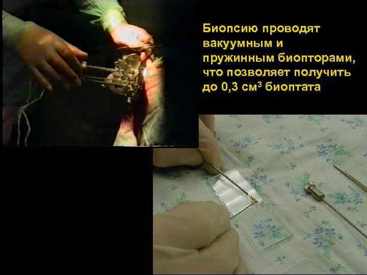 Биопсию проводят вакуумным и пружинным биопторами, что позволяет получить до 0, 3 см 3