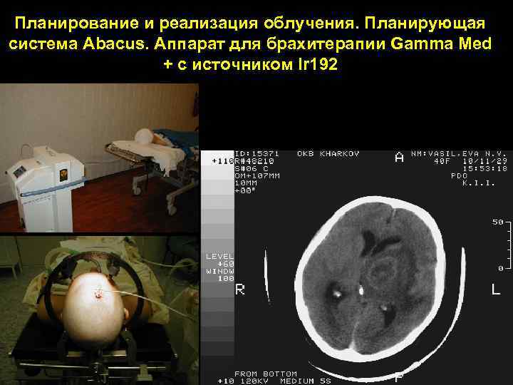Планирование и реализация облучения. Планирующая система Abacus. Аппарат для брахитерапии Gamma Med + с