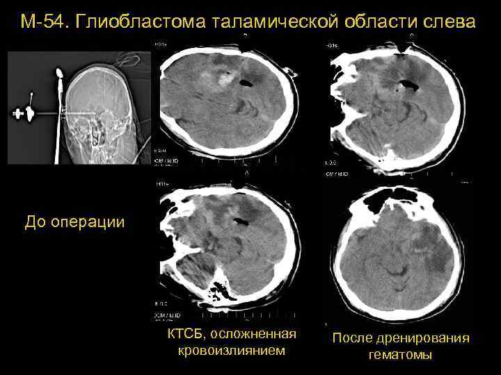 М-54. Глиобластома таламической области слева До операции КТСБ, осложненная кровоизлиянием После дренирования 73 гематомы