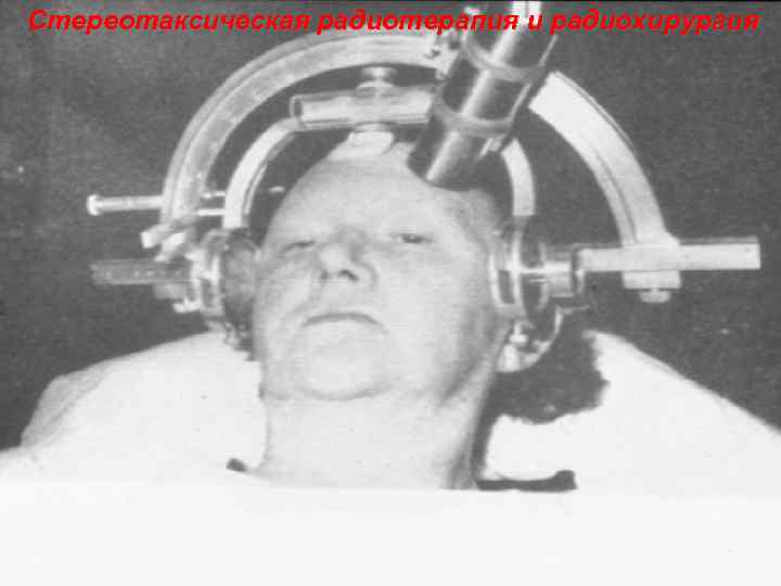 Стереотаксическая радиотерапия и радиохирургия 75 