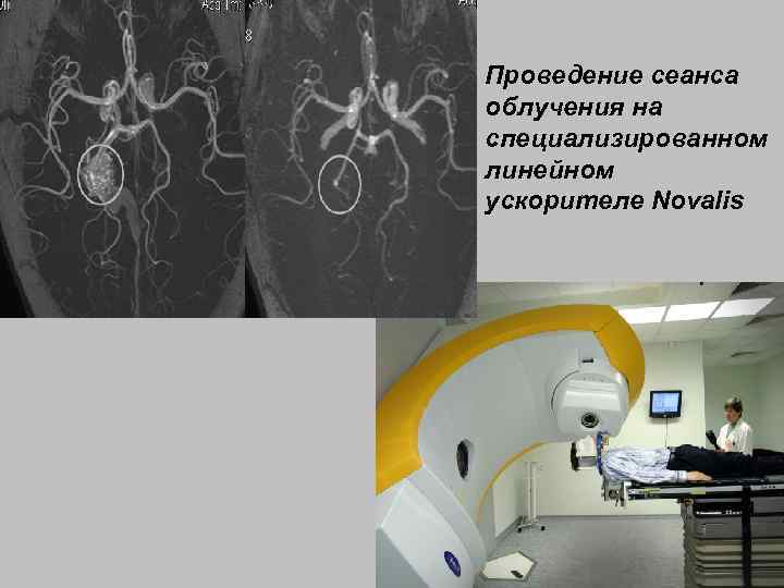 Проведение сеанса облучения на специализированном линейном ускорителе Novalis 81 