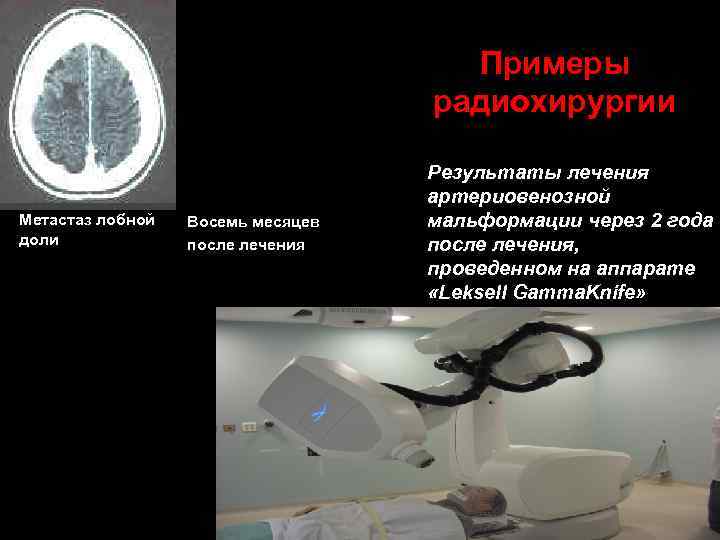Примеры радиохирургии Метастаз лобной доли Восемь месяцев после лечения Результаты лечения артериовенозной мальформации через