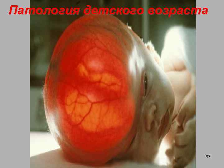 Патология детского возраста 87 