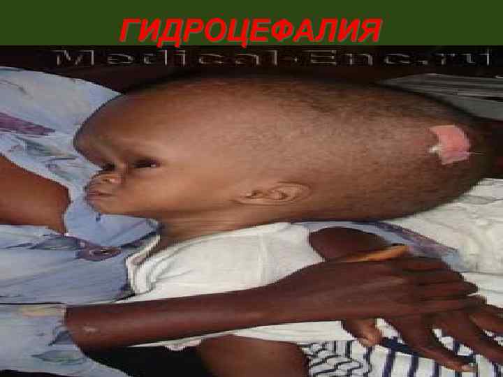 ГИДРОЦЕФАЛИЯ 88 