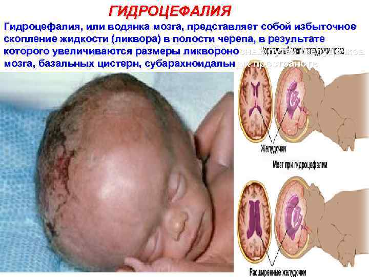 ГИДРОЦЕФАЛИЯ Гидроцефалия, или водянка мозга, представляет собой избыточное скопление жидкости (ликвора) в полости черепа,