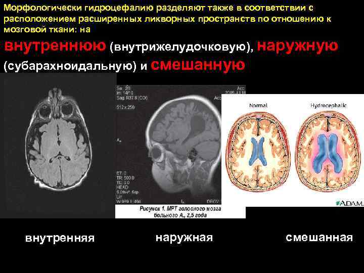 Картина наружной гидроцефалии