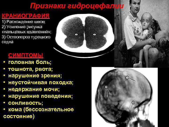Признаки гидроцефалии КРАНИОГРАФИЯ 1) Расхождение швов; 2) Усиление рисунка «пальцевых вдавлений» ; 3) Остеопороз