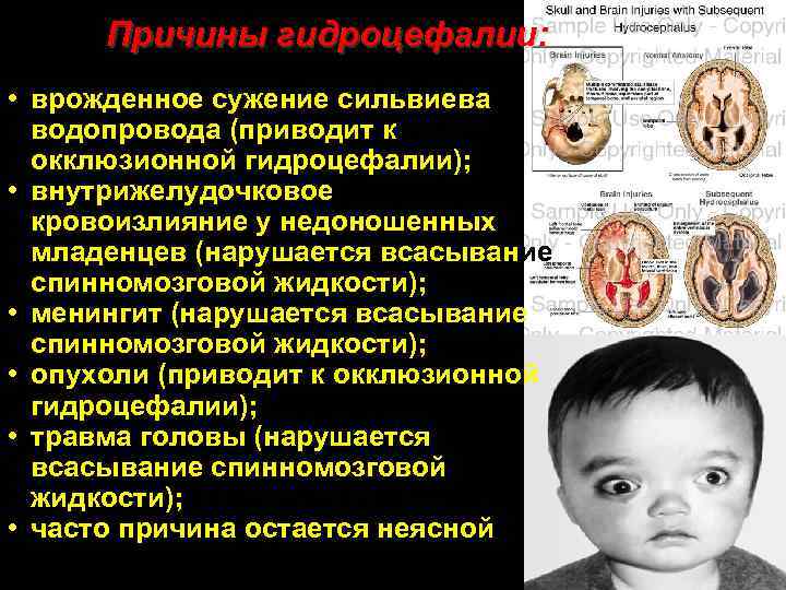 Причины гидроцефалии: • врожденное сужение сильвиева водопровода (приводит к окклюзионной гидроцефалии); • внутрижелудочковое кровоизлияние