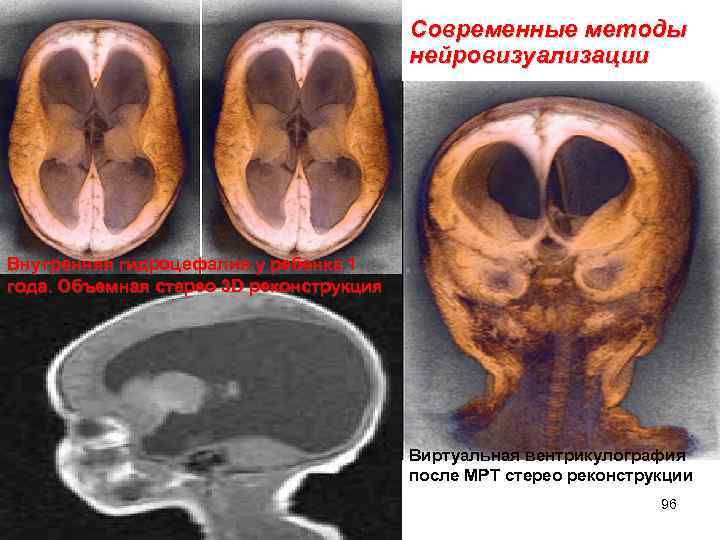 Современные методы нейровизуализации Внутренняя гидроцефалия у ребенка 1 года. Объемная стерео 3 D реконструкция
