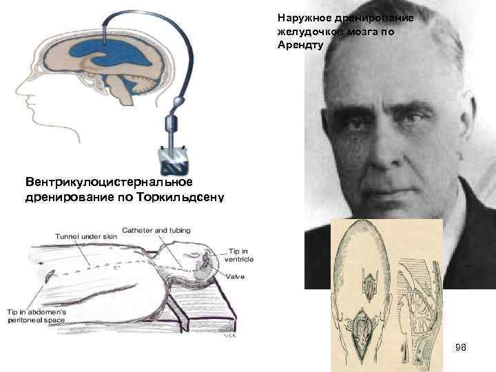 Наружное дренирование желудочков мозга по Арендту Вентрикулоцистернальное дренирование по Торкильдсену 98 