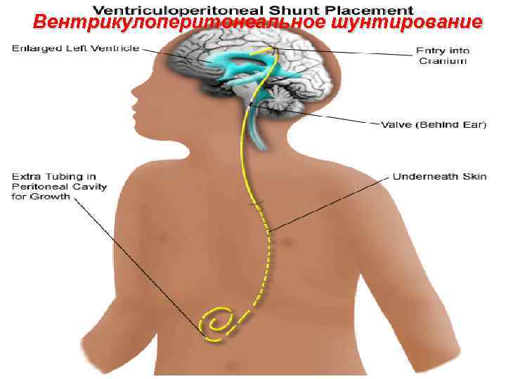  Вентрикулоперитонеальное шунтирование 99 