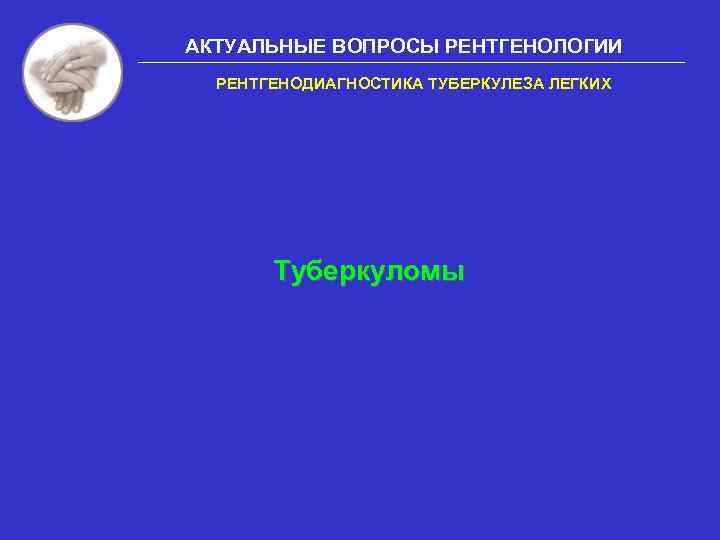 АКТУАЛЬНЫЕ ВОПРОСЫ РЕНТГЕНОЛОГИИ РЕНТГЕНОДИАГНОСТИКА ТУБЕРКУЛЕЗА ЛЕГКИХ Туберкуломы 
