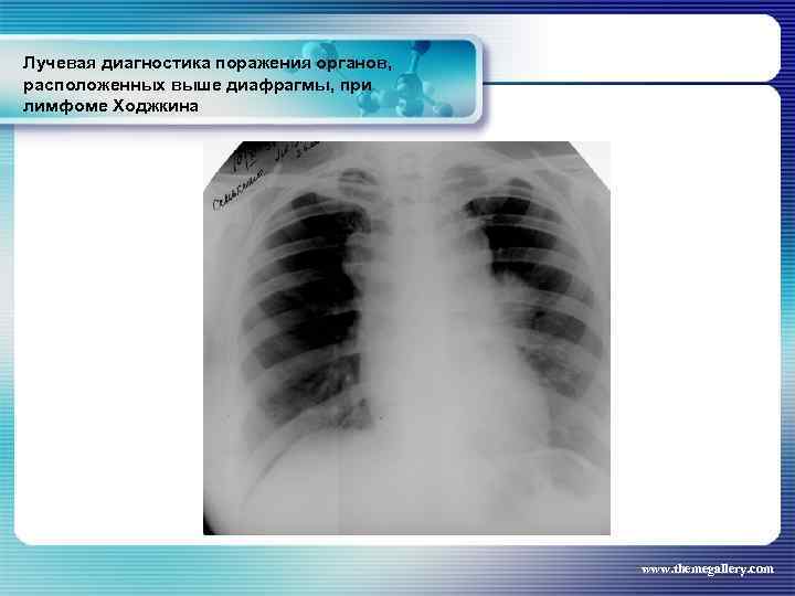 Лучевая диагностика поражения органов, расположенных выше диафрагмы, при лимфоме Ходжкина www. themegallery. com 