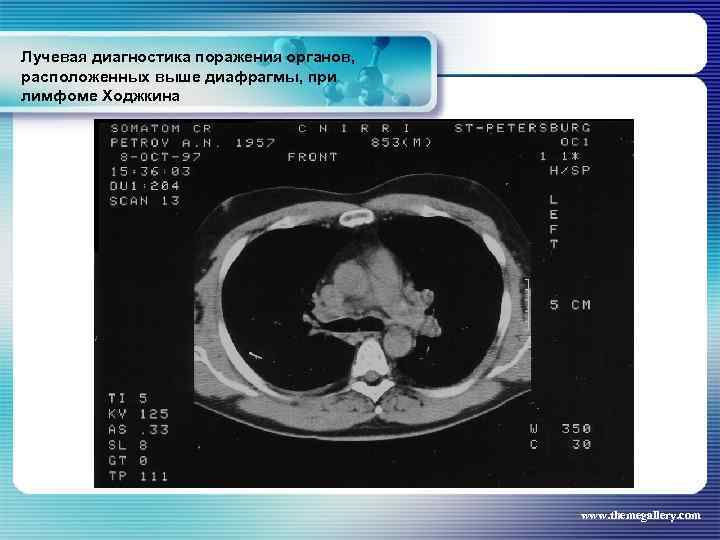 Лучевая диагностика поражения органов, расположенных выше диафрагмы, при лимфоме Ходжкина www. themegallery. com 