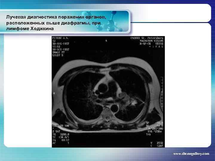 Лучевая диагностика поражения органов, расположенных выше диафрагмы, при лимфоме Ходжкина www. themegallery. com 
