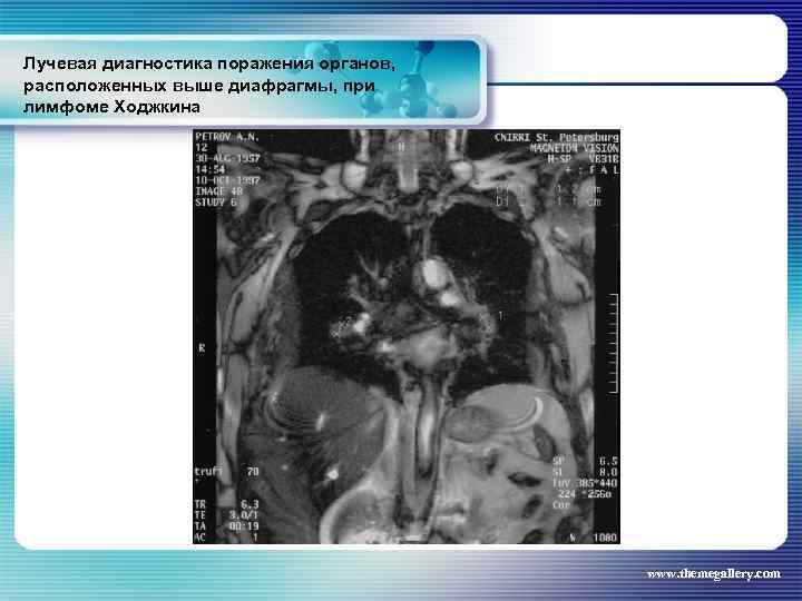 Лучевая диагностика поражения органов, расположенных выше диафрагмы, при лимфоме Ходжкина www. themegallery. com 