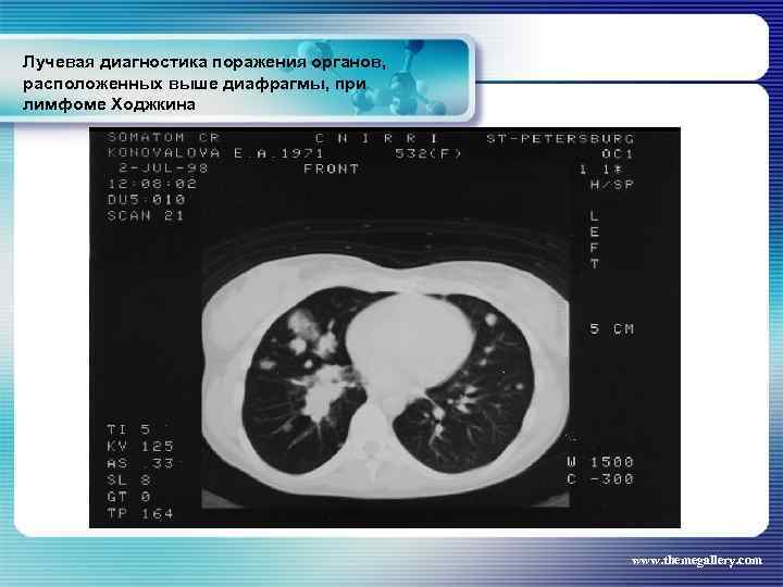 Лучевая диагностика поражения органов, расположенных выше диафрагмы, при лимфоме Ходжкина www. themegallery. com 
