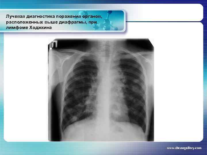 Лучевая диагностика поражения органов, расположенных выше диафрагмы, при лимфоме Ходжкина www. themegallery. com 