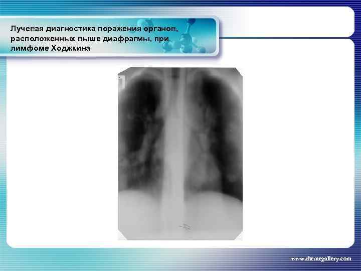 Лучевая диагностика поражения органов, расположенных выше диафрагмы, при лимфоме Ходжкина www. themegallery. com 