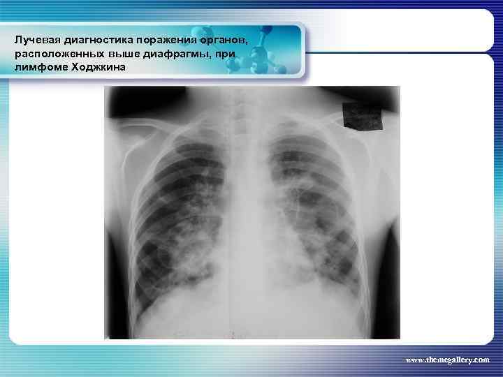 Лучевая диагностика поражения органов, расположенных выше диафрагмы, при лимфоме Ходжкина www. themegallery. com 