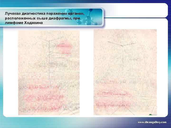 Лучевая диагностика поражения органов, расположенных выше диафрагмы, при лимфоме Ходжкина www. themegallery. com 