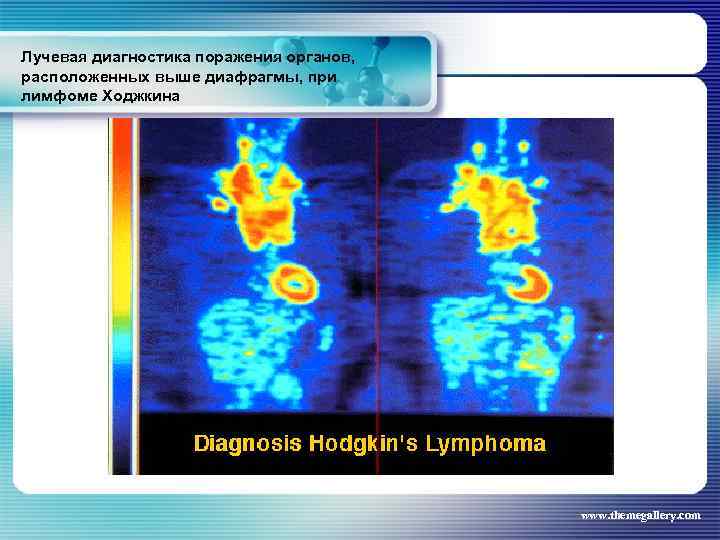 Лучевая диагностика поражения органов, расположенных выше диафрагмы, при лимфоме Ходжкина www. themegallery. com 