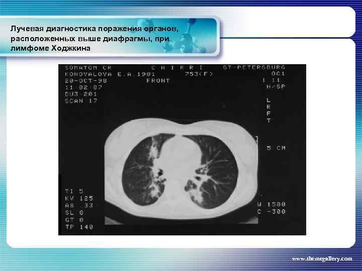 Лучевая диагностика поражения органов, расположенных выше диафрагмы, при лимфоме Ходжкина www. themegallery. com 