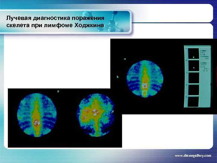 Лучевая диагностика поражения скелета при лимфоме Ходжкина www. themegallery. com 