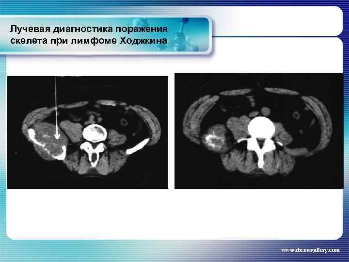 Лучевая диагностика поражения скелета при лимфоме Ходжкина www. themegallery. com 