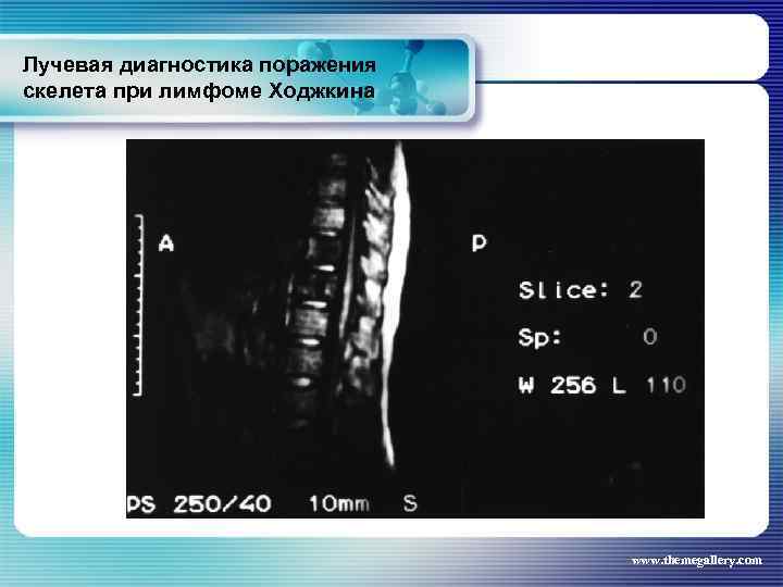 Лучевая диагностика поражения скелета при лимфоме Ходжкина www. themegallery. com 
