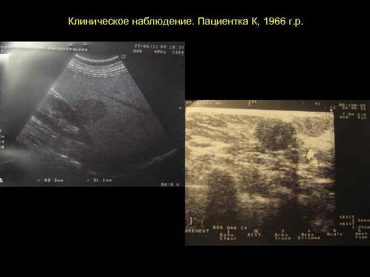 Клиническое наблюдение. Пациентка К, 1966 г. р. 
