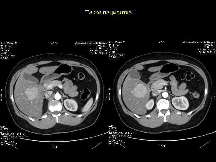 Та же пациентка 