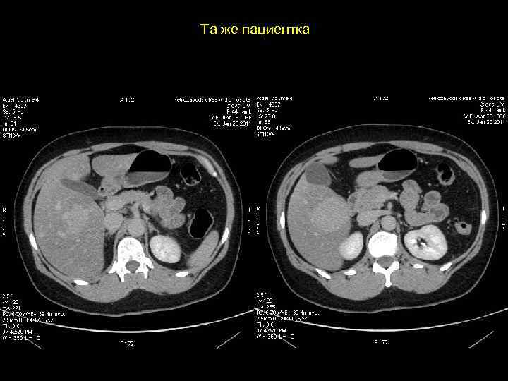 Та же пациентка 