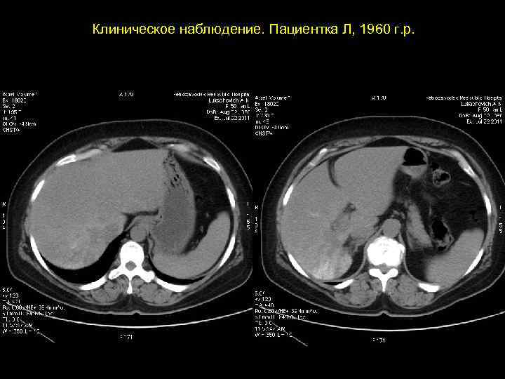 Клиническое наблюдение. Пациентка Л, 1960 г. р. 