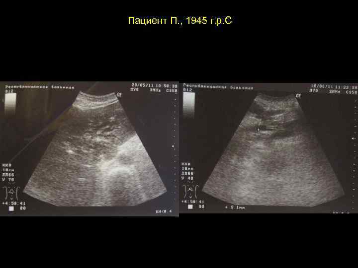 Пациент П. , 1945 г. р. С 