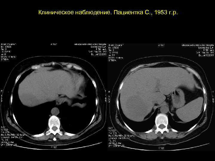 Клиническое наблюдение. Пациентка С. , 1953 г. р. 